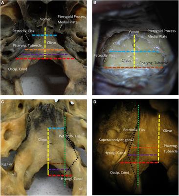 Endoscopy-assisted high anterior cervical approach in craniovertebral junction (CVJ)